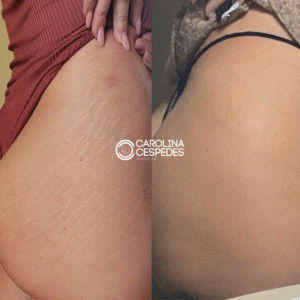 Antes y después Carolina Céspedes (11)