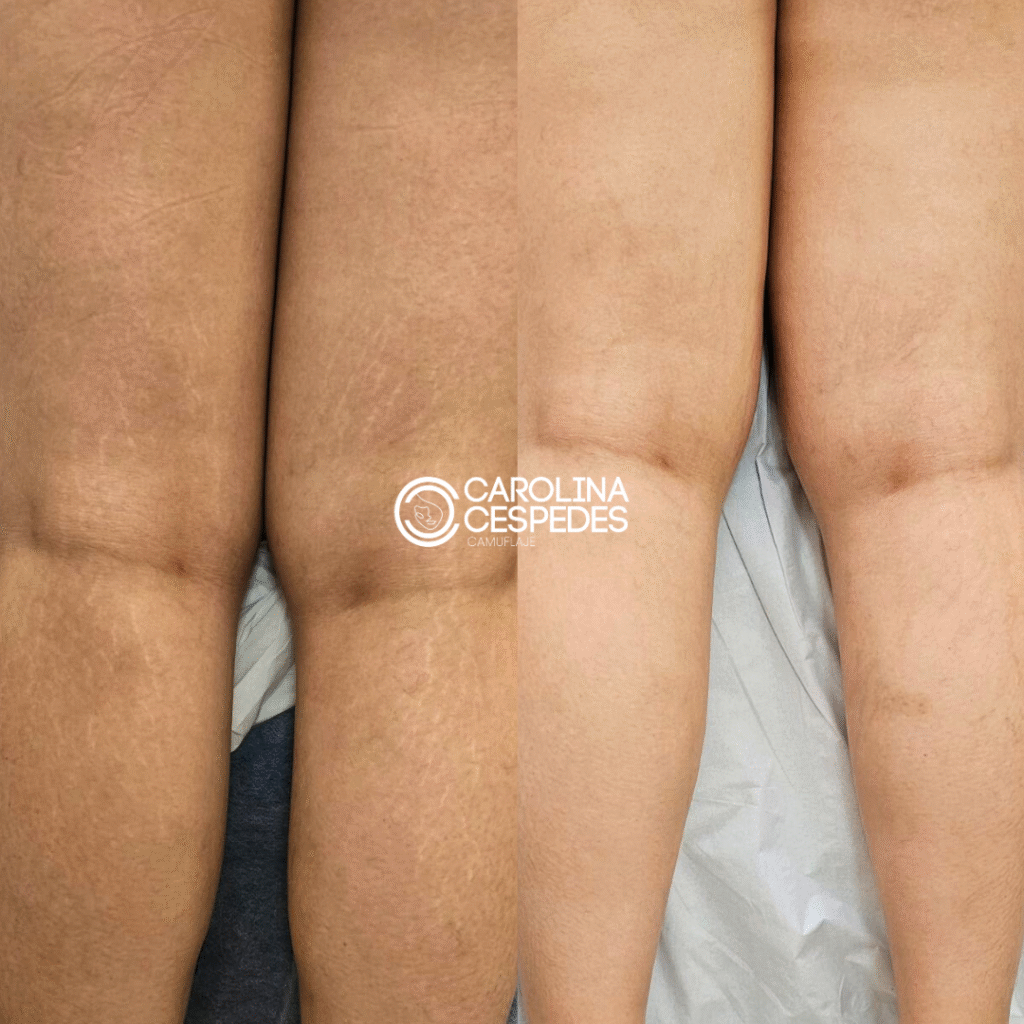 Antes y después Carolina Céspedes (12)