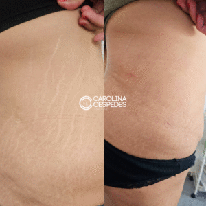 Antes y después Carolina Céspedes (17)