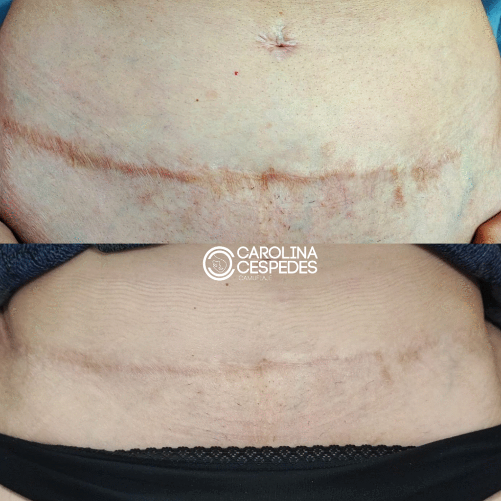 Antes y después Carolina Céspedes (19)