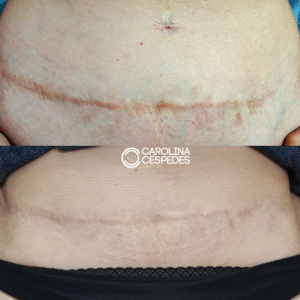 Antes y después Carolina Céspedes (19)