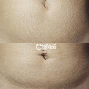 Antes y después Carolina Céspedes (20)