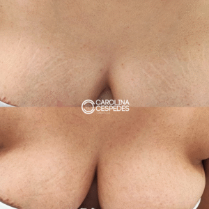 Antes y después Carolina Céspedes (21)