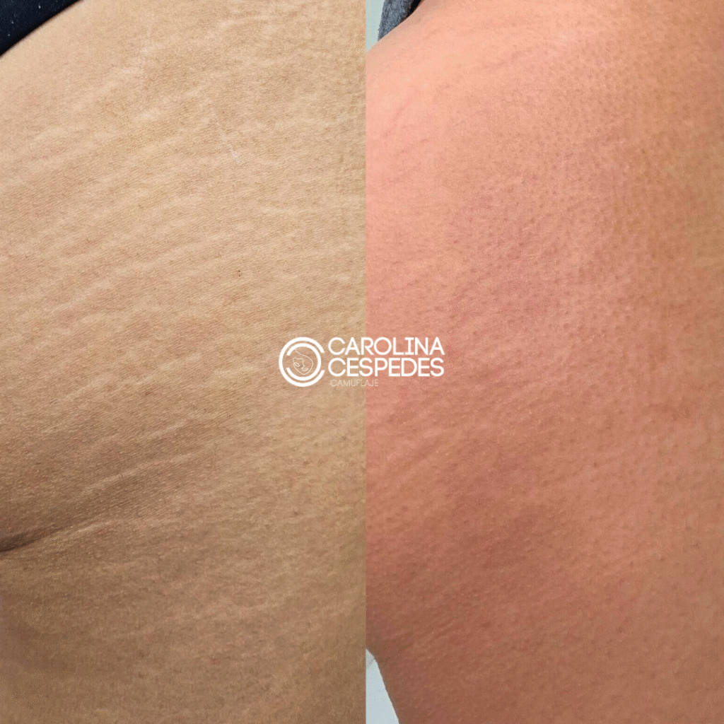 Antes y después Carolina Céspedes (22)