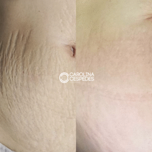 Antes y después Carolina Céspedes (5)