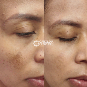 Antes y después Carolina Céspedes (8)